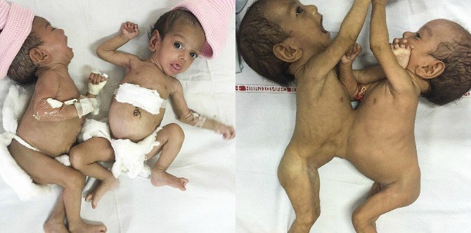 Conjoined twins separated for the first time in their life