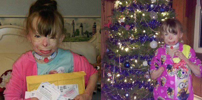 Girl with severe burns only wants Christmas cards for Christmas