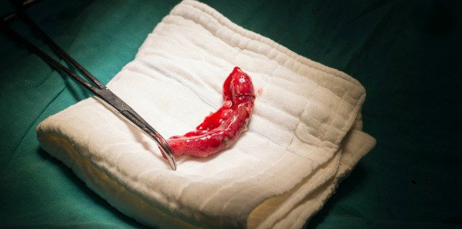 Antibiotics better than appendix surgery for kids: Study