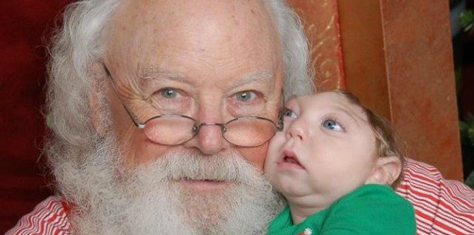 Adorable baby with half a head and skull meets Santa for the first time