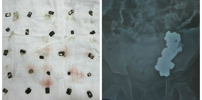 X-Ray reveals 3-year-old Indian boy swallowed 29 magnets