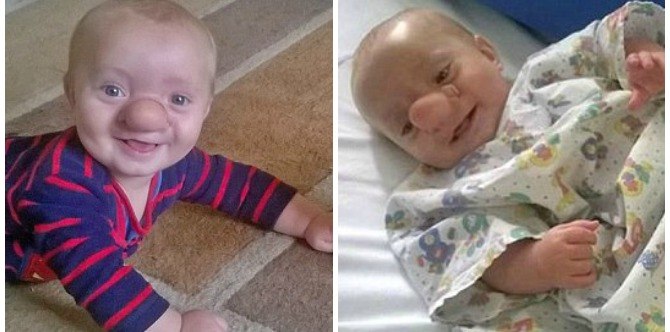 Meet the toddler whose brain grows through his nose