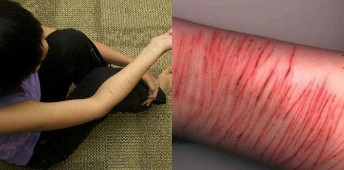 Self-mutilation increasingly prevalent among Singapore youth, studies show