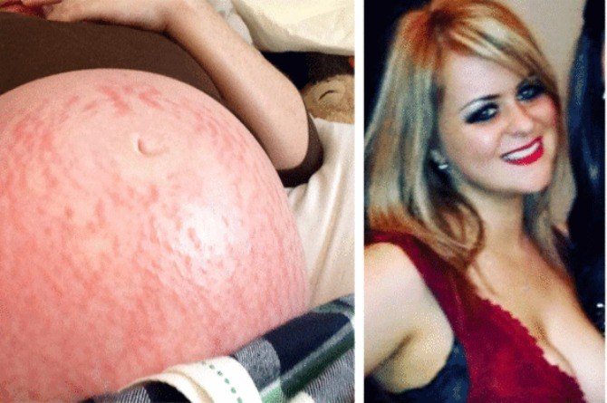 This Mother Discovered She Was Allergic To Being Pregnant!