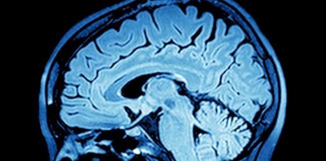 Girl missing a chunk of her brain still alive at 10