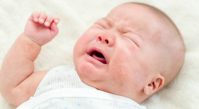 What parents should know about childhood eczema (and how to help)