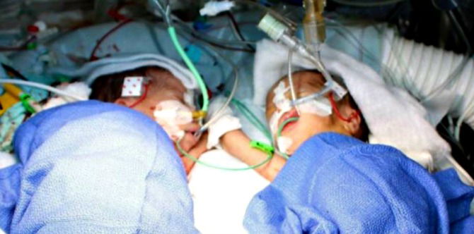 8-day-old conjoined twins successfully separated at Swiss hospital