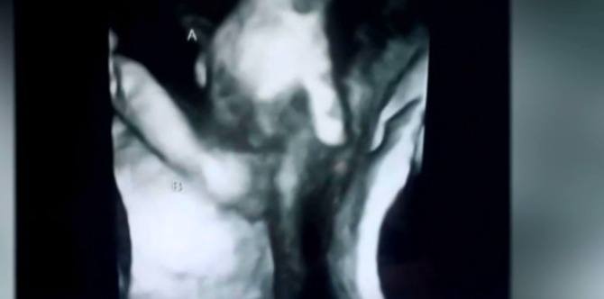 Sonogram shows baby holding hands with her dying twin brother