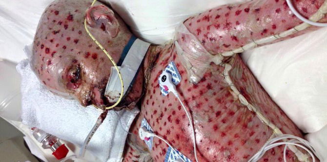 A severe allergic reaction caused his skin to separate from his body
