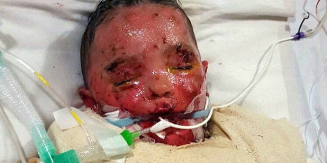 Toddler nearly lost his life after he was misdiagnosed with chicken pox