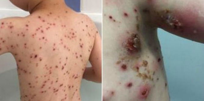 Avoid this chicken pox mistake at all cost!