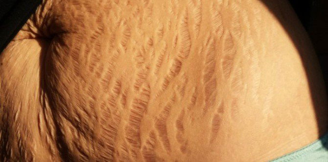 A mum’s candid confession: “A baby ruined my body”