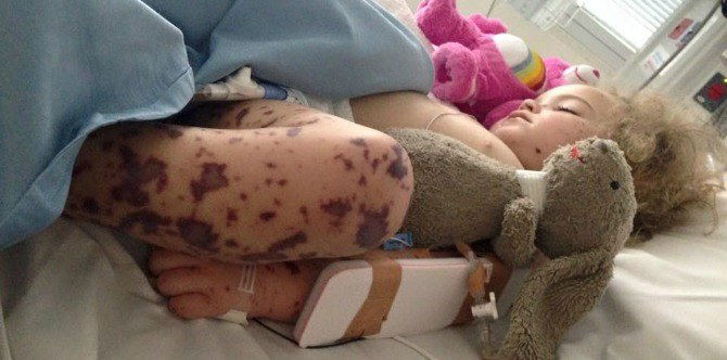 Heat rash turns out to be a deadly infection, now mum warns others