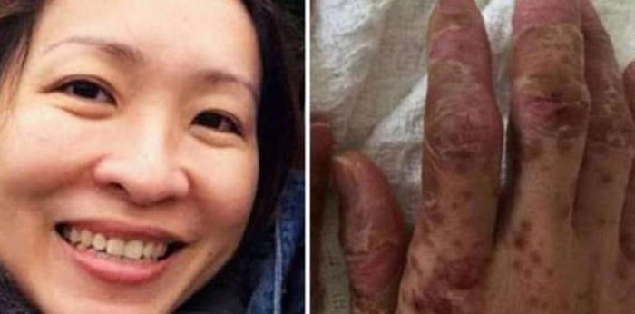 Singaporean Mum Catches HFMD: Adults Can Get HFMD