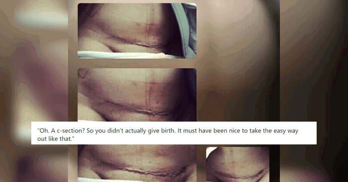 Mum's Viral Post Slams Notion That C-sections Are "Easy Way Out"
