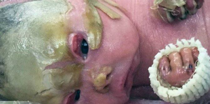 Genetic condition causes skin layers to shed every 4 to 8 hours