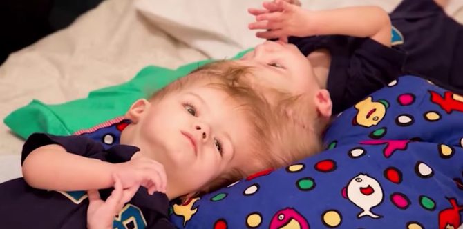 Twins conjoined at the head finally separated after 16 hour surgery