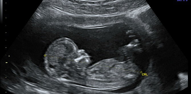 Ultrasound Exposure During First Trimester Can Heighten the Severity of Autism