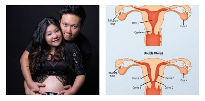 Read the Story of This Singapore Mum With Two Uteruses!