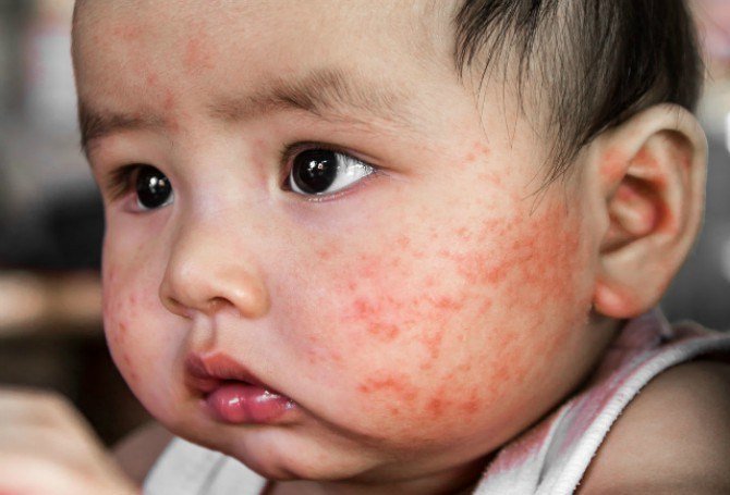 baby eczema