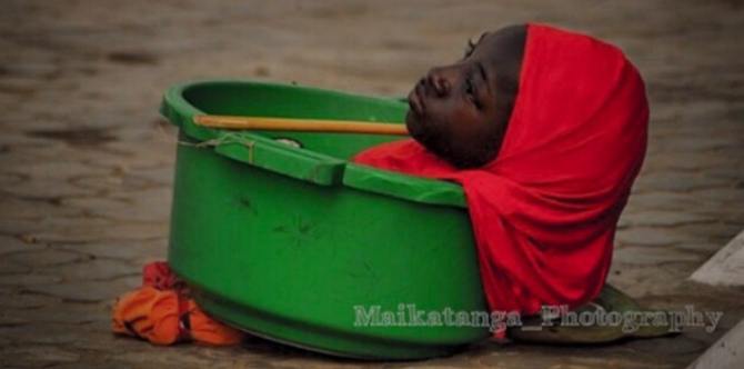 Limbless teen who lived in a plastic bowl has passed away