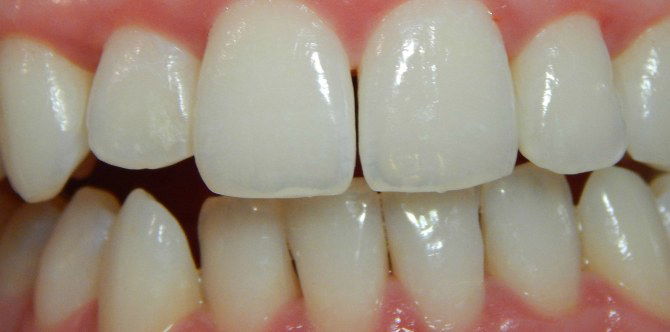 Severe gum disease might cause rheumatoid arthritis