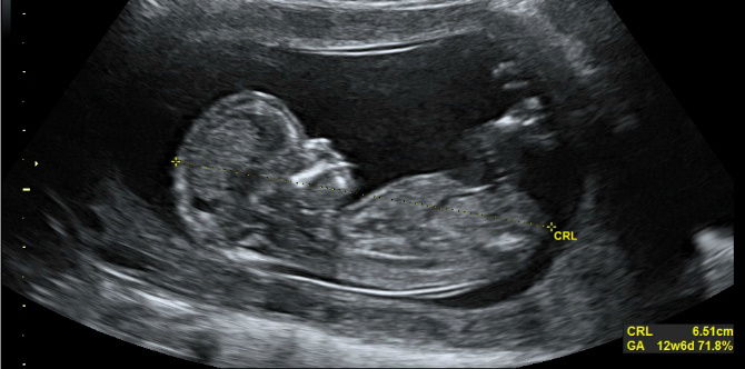 A Singaporean Father's Pregnancy Diary: Should We Find Out Baby's Gender?