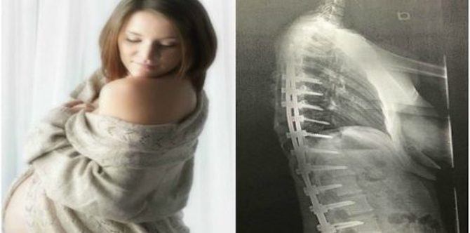 'Scoliosis won't let me get into the birthing position': Katelyn Treichel