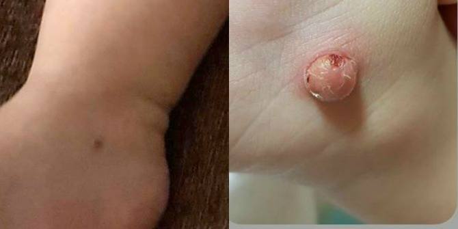 Singapore Mum Horrified to See Baby's Bug Bite Grow Bigger and Bigger!