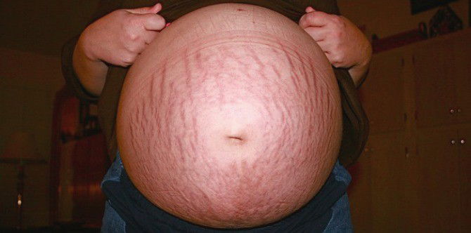 Clifford Clinic has a quick solution for your motherhood stretch marks