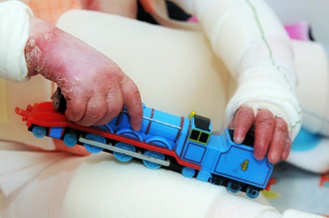 "If we were not careful, his fingers would fuse together"