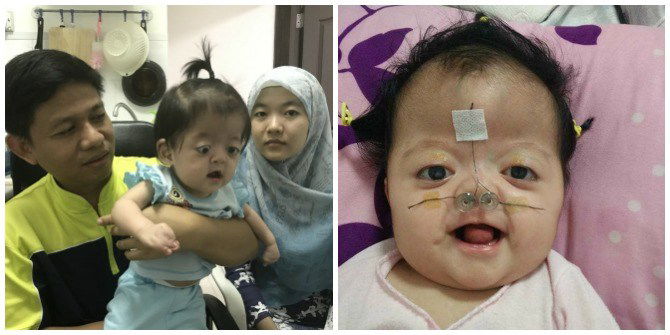 Baby with Apert Syndrome in Singapore needs HELP for treatment!