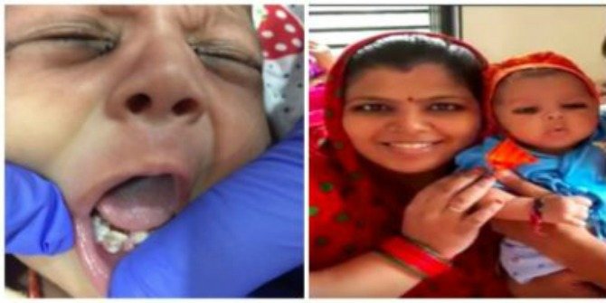 OMG! Indian baby born with 7 fully-developed teeth!