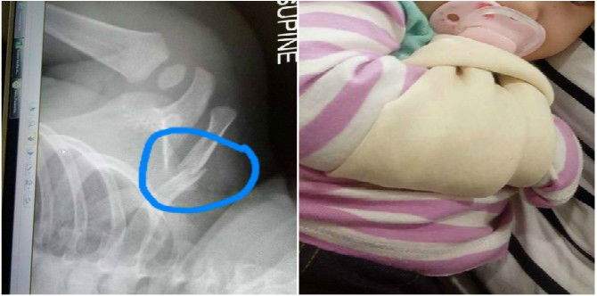 7-month-old Singapore Baby Falls Off Bed, Breaks Collar Bone