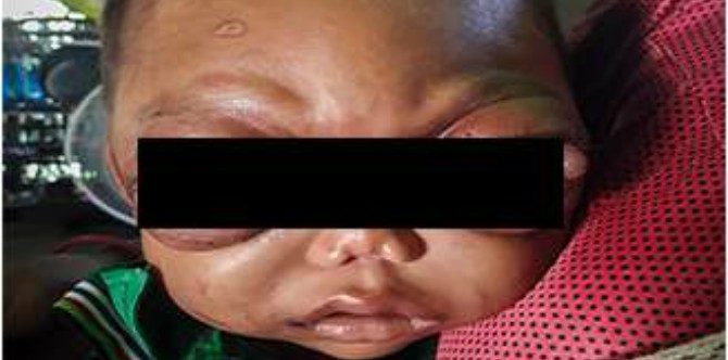 Rare disorder leaves 2-year-old with protruding eyes