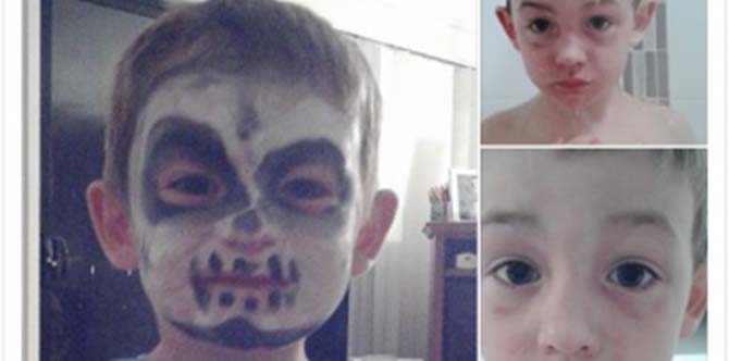Face painting dangers: Child's face burnt by Halloween face paint