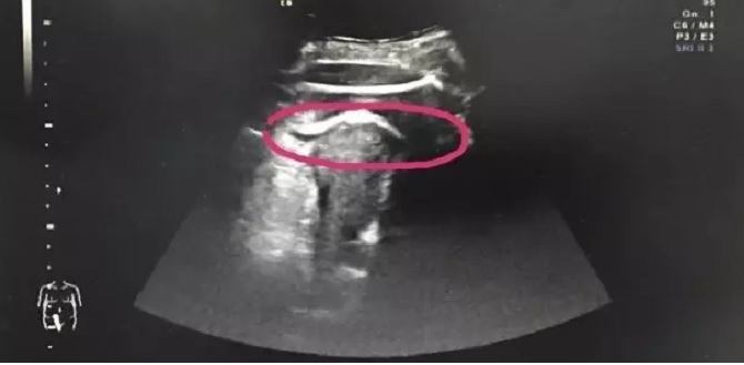 This Pregnant Mummy Nearly DIED From Her Baby's Kick!