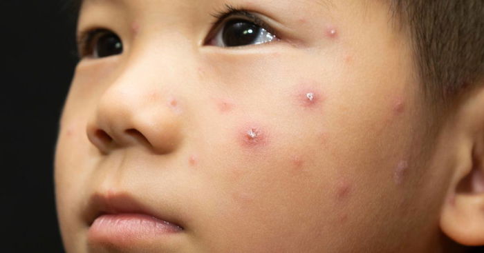 How to Prevent Preteen Acne: Beyond the Basics