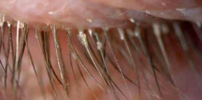 Over 100 eye parasites caused this woman's eye itching and redness