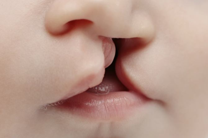 My 'Friend' Assumed I'd Be Pro Abortion for Cleft Babies Like Mine & He's Dead Wrong