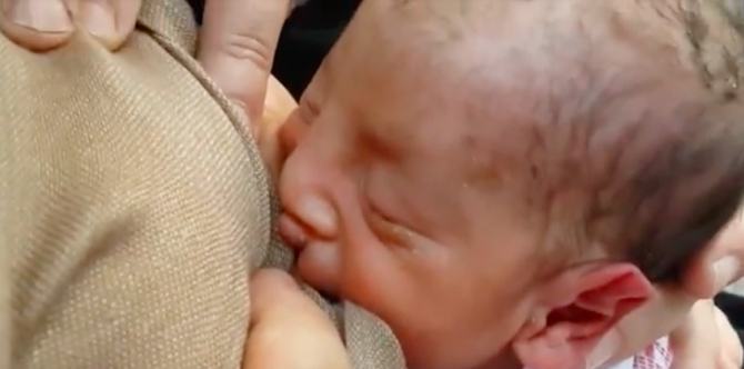 Breastfeeding Babies With Cleft Lip or Palate