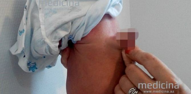 OMG! Baby Boy Born With an Extra Penis on His Back 'Terrifies' Doctors
