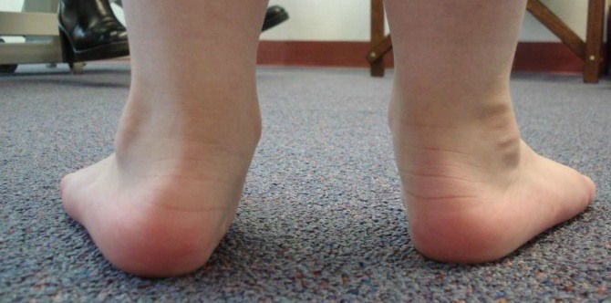 Flatfoot in Children: How to Identify and Correct It to Prevent Disadvantages