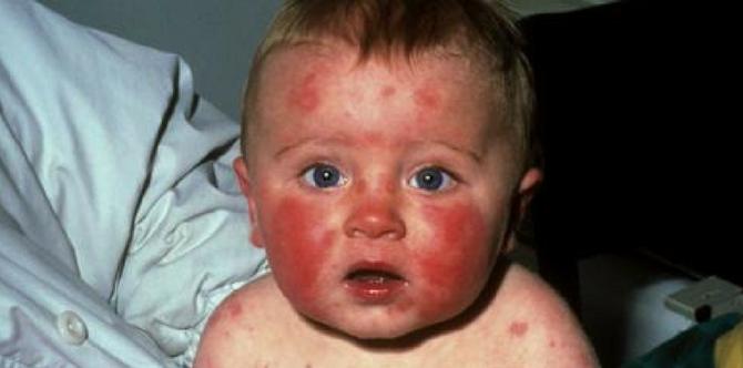 Fifth Disease: What Parents Must Know About This Common Kids' Condition