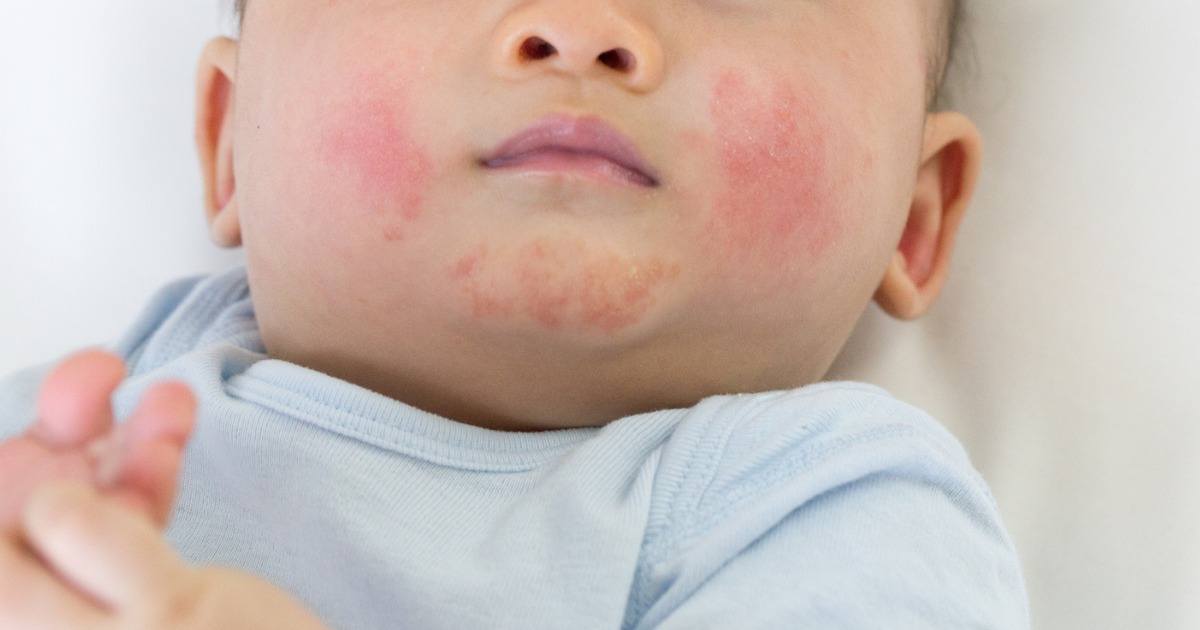 Fifth Disease All You Need To Know About This Common Condition