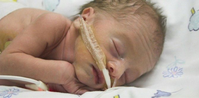 Study: Babies Born Prematurely Are More Prone To Bone Defects