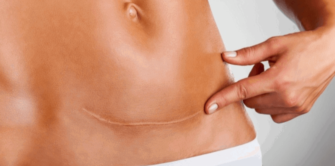 Tummy Tuck After Pregnancy Helps Reduce Back Pain And Incontinence