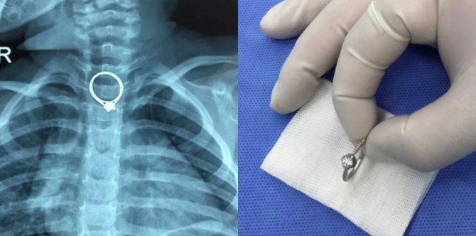 Toddler Swallows Mum's Ring: Keep Small Objects Out of Reach!