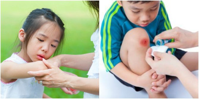 Treating Wounds In Children: 4 Common Misconceptions