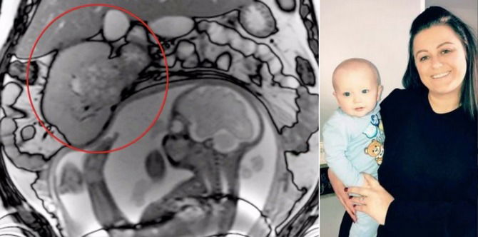 Mother Credits Her Unborn Son For Saving Her From A Potentially Deadly Cancer